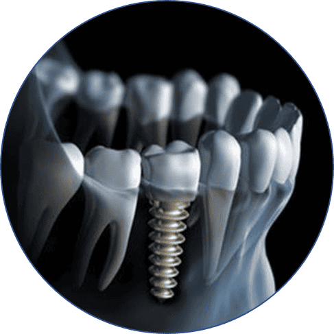 Implants