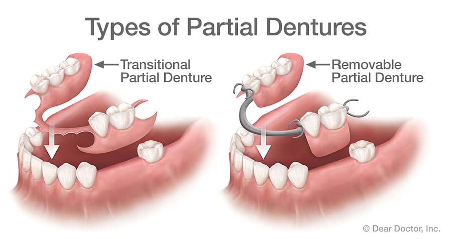 Partial and Complete Dentures